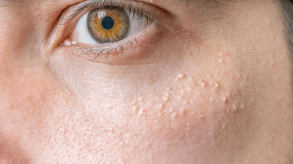 Hydration And Milia