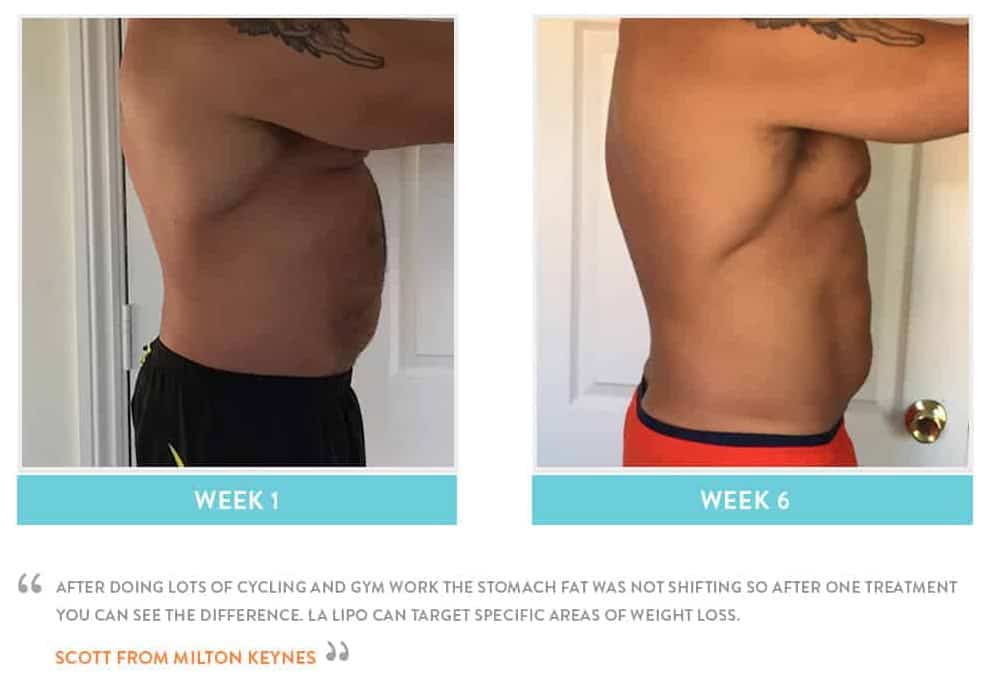 Before & After Stomach Fat Chester