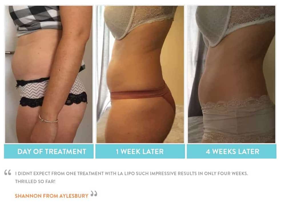 before, Cryolipolysis Chester