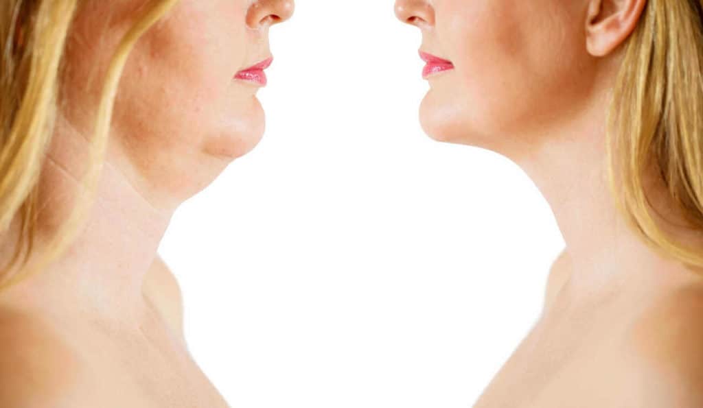 Double Chin treatment Chester before and after results