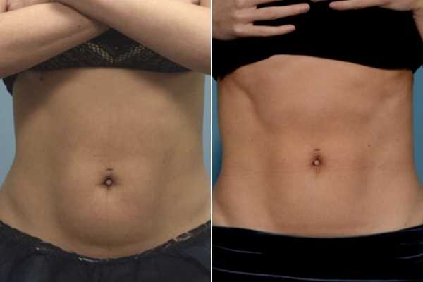 body sculpting FAQs Chester