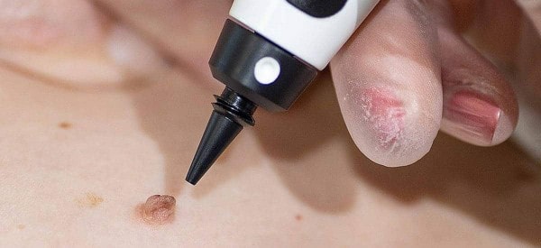 After Skin Tag Removal Chester