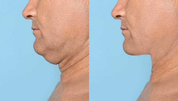 Which Non-Surgical Treatments Work Best for Jowls and Loose Skin Chester?