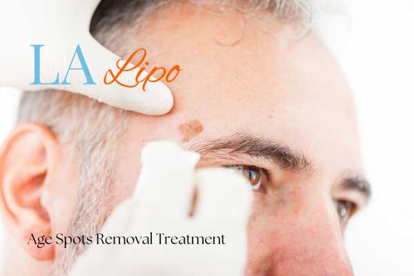 What Are the Most Effective Treatments for Age Spots Chester?