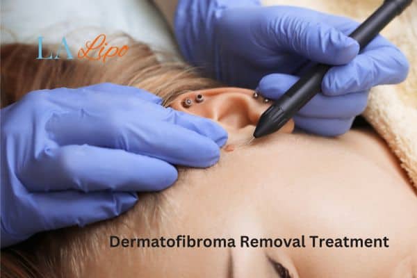 Dermatofibroma Removal Treatment Chester