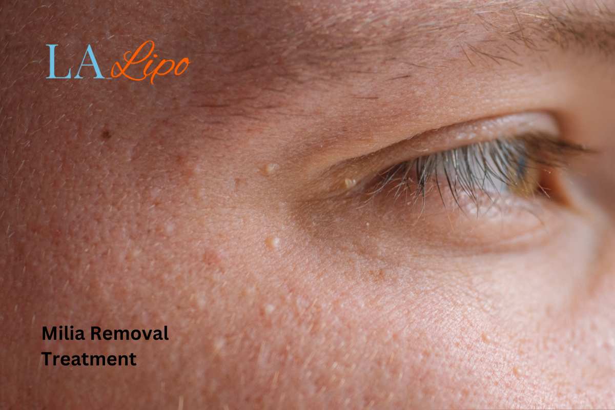 Cryopen Milia Removal: Is It the Easiest and Safest Option Chester?