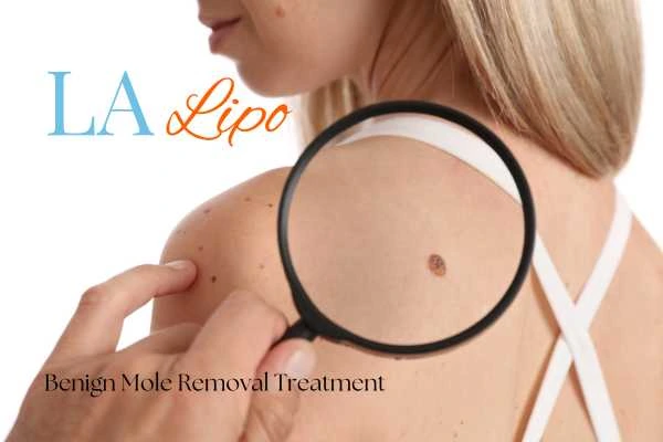 Woman having her inspection of blemish before mole removal Chester