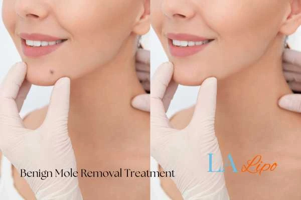 woman's before and after mole removal Chester results