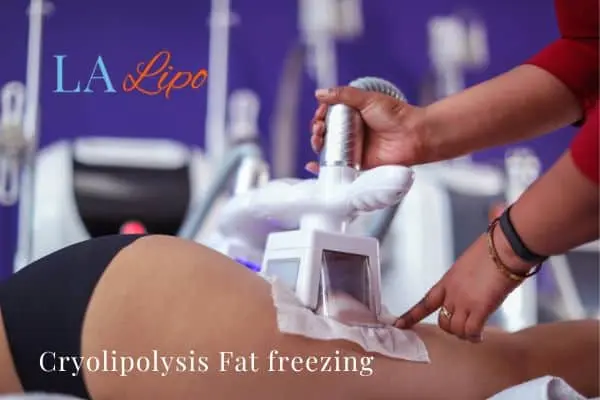 women getting fat freezing Chester