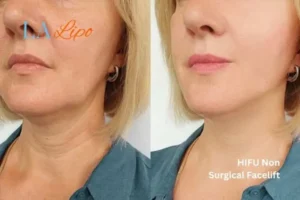 hi-fu for wrinkles Chester before and after results