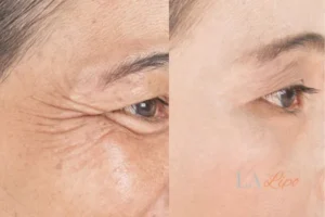 Before and after results of woman - HI-fu wrinkles reduction treatment Chester