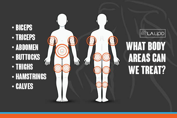 Graphic to show areas you can have LA-EMS Body Sculpting Chester treatment.