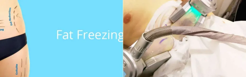 Fat freezing Chester on multiple areas of the body