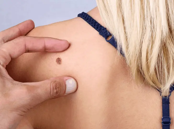 woman having mole removal Chester consultation before treatment.