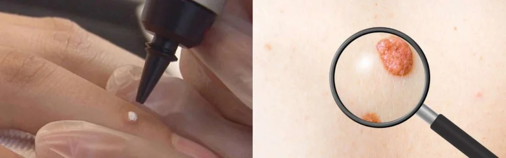 Person getting moles removed with cryopen Chester