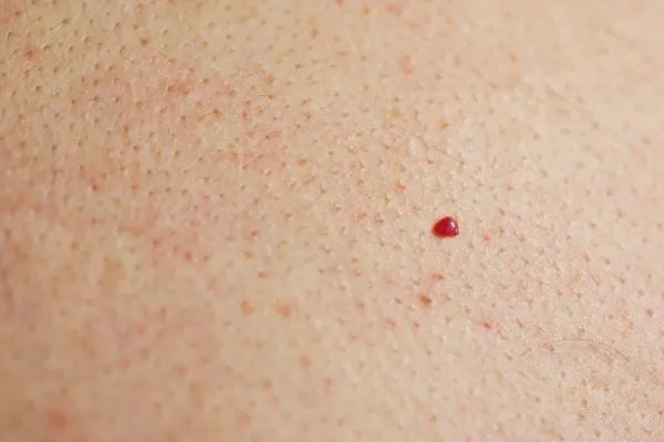 close up of a cherry angioma Chester