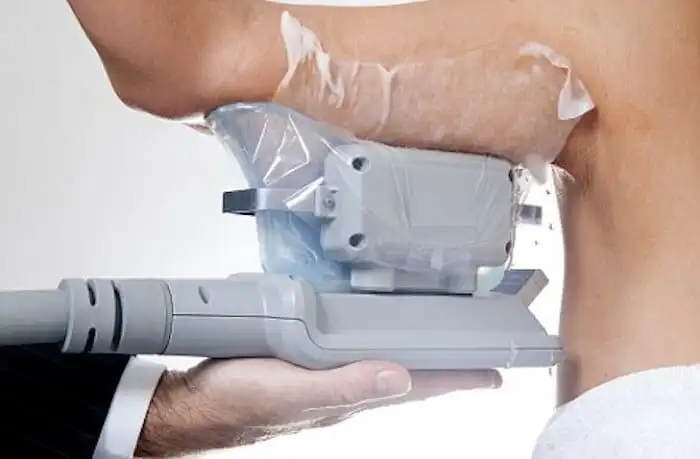 Picture of fat freezing Chester on the upper arms.