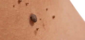 image of a skin tag Chester