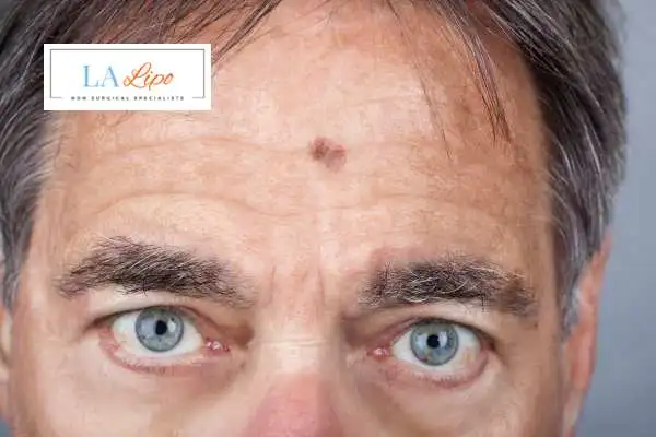 Solar Lentigo Removal Chester image of man with mark on his forehead
