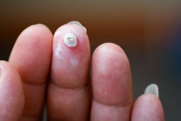wart on person finger - cryotherapy to treat from LA LIPO Chester