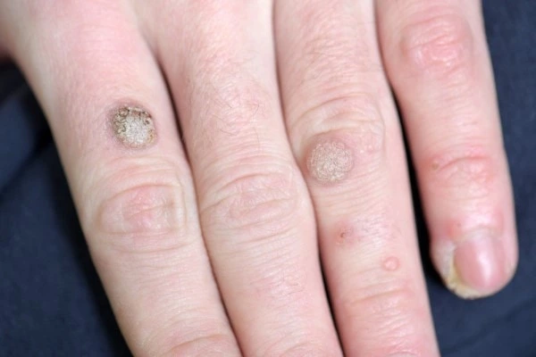 photo of warts on person hand - see wart removal Chester from LA LIPO