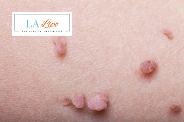 Does cryopen skin tag removal Chester hurt? Find out now call our team today!