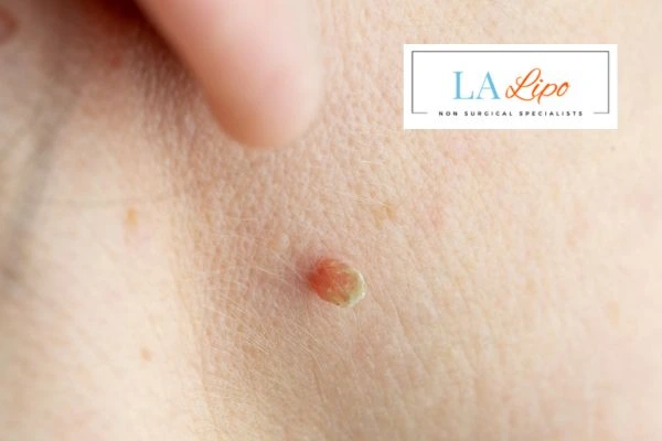 Book skin tag removal Chester today speak to our team now!