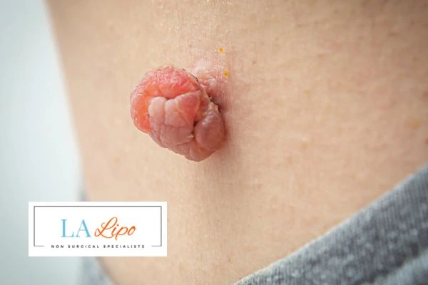 Interested in skin tag removal Chester? Concerned about the pain? Find out more today!