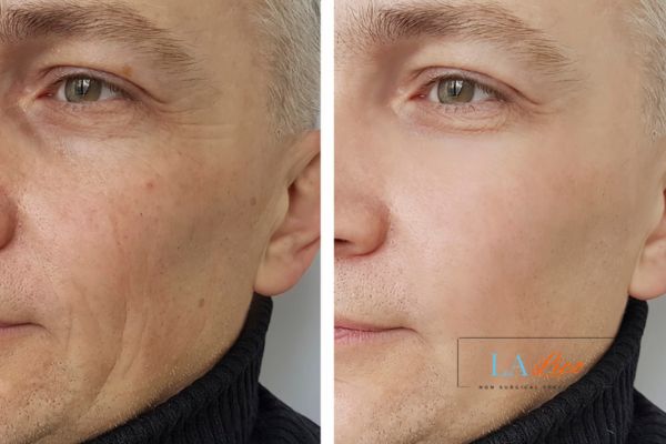 See the amazing results of Morpheus8 Treatment Chester!
