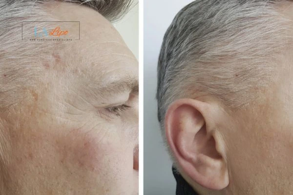 Mens Before & After Morpheus 8 Results Chester