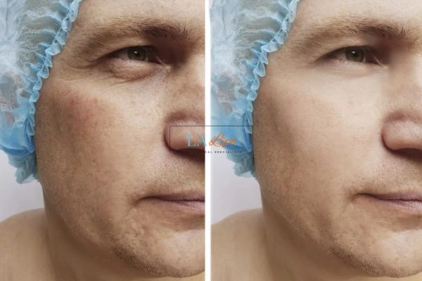 Before and after Morpheus 8 Results Chester