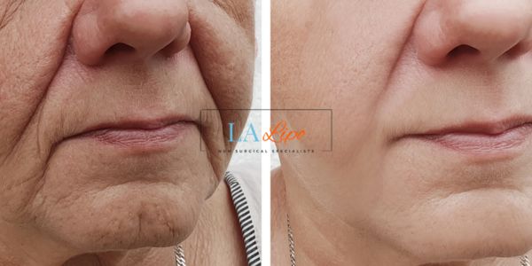 Older lady deeper wrinkle reduction - LA LIPO Morpheus 8 Results Chester