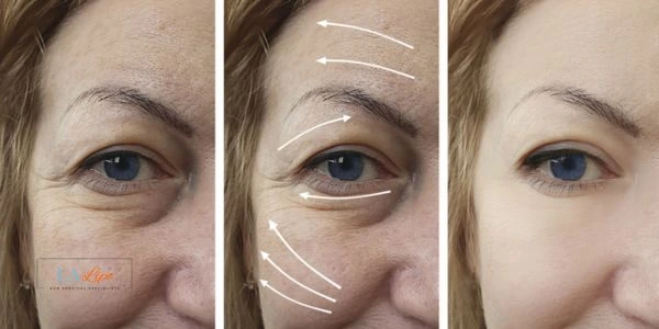 Amazing eye lift Morpheus 8 results Chester
