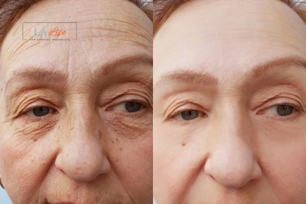 The powerful benefits of Morpheus8 Treatment Chester - Call Our team today!