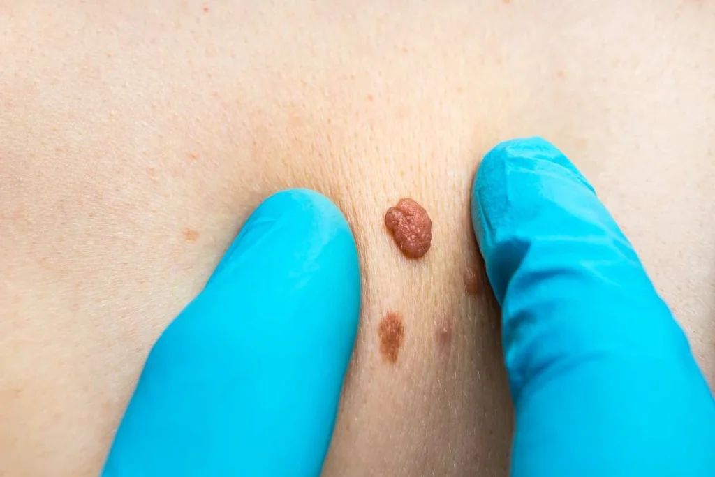 LA LIPO Cryopen Lesion Removal Prices Chester