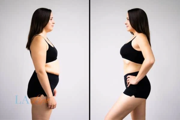 Picture of womans before and after using LA-EMS body sculpting to improve her core strength Chester