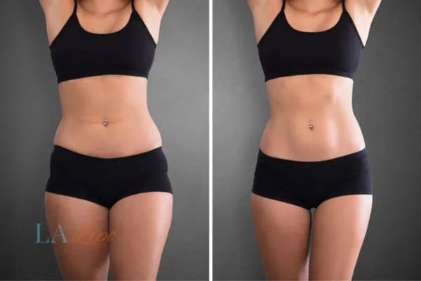 before and after results of non-surgical treatment to help a woman's body image and mental health Chester