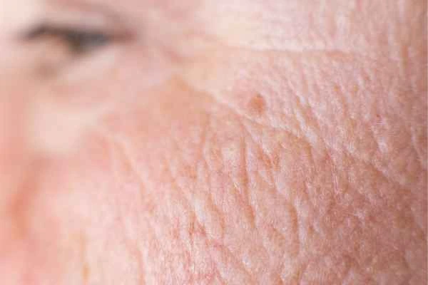 close up picture of a woman's face showing an age spot Chester