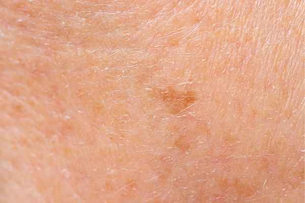 close up picture of age spots Chester
