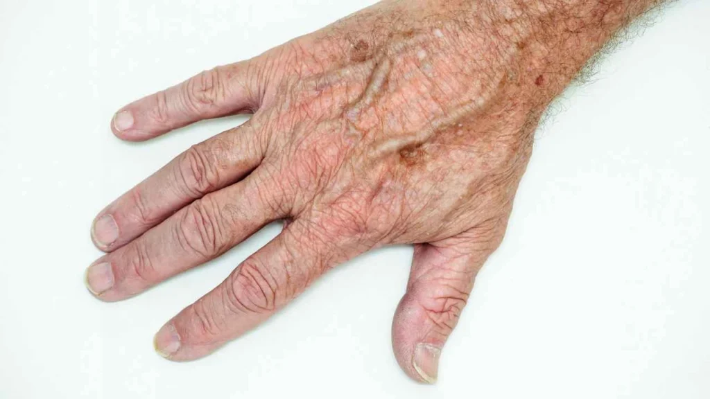 Male hand showing age spot Chester