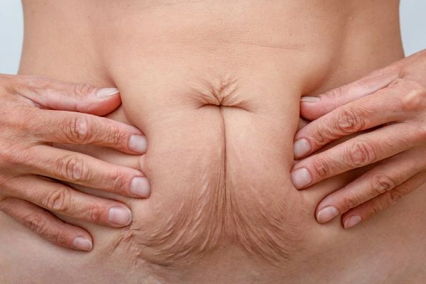 Image of a woman's stomach with loose skin - example of skin tightening Chester options