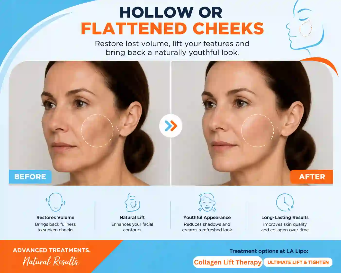 Sign #4: Hollow or Flattened Cheeks Chester